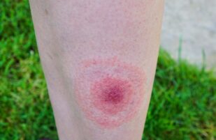 Lyme disease: Know the signs and symptoms