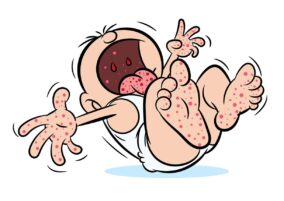 What is Hand, Foot and Mouth Disease?
