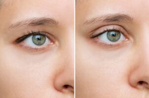 What is a blepharoplasty?