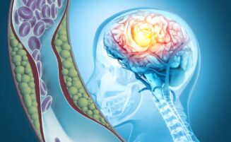 One in six U.S. deaths due to stroke